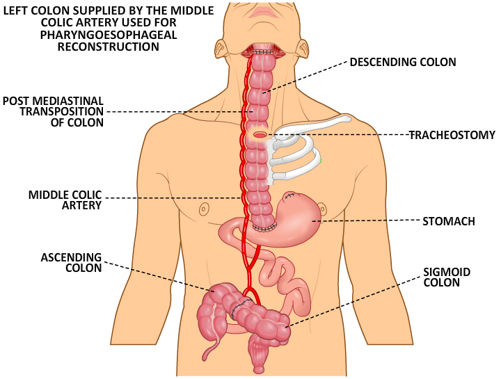 Pharyngoesophageal Reconstruction - Colon